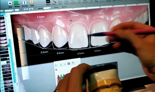 Diseño de la sonrisa imagen del programa de Diseño de la sonrisa