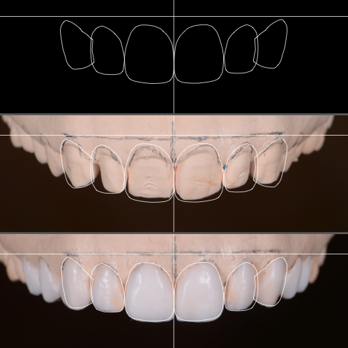 progreso Diseño de la sonrisa imagen del programa de Diseño de la sonrisa