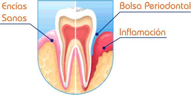 PERIODONCIA