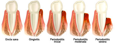 PERIODONCIA2