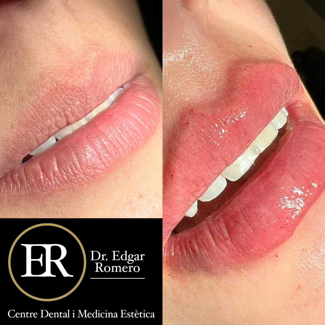 Resultados del Rejuvenecimiento Facial en Sabadell Resultados del rejuvenecimiento facial con ácido hialurónico en la Clínica Dental Edgar Romero en Sabadell.