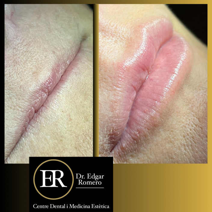 21 Antes y Después de ácido hialurónico