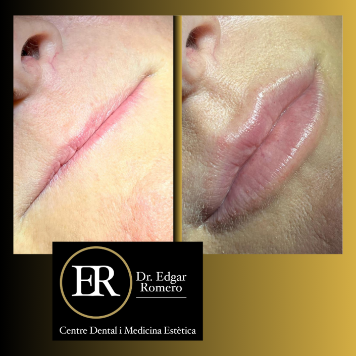 22 Antes y Después de ácido hialurónico