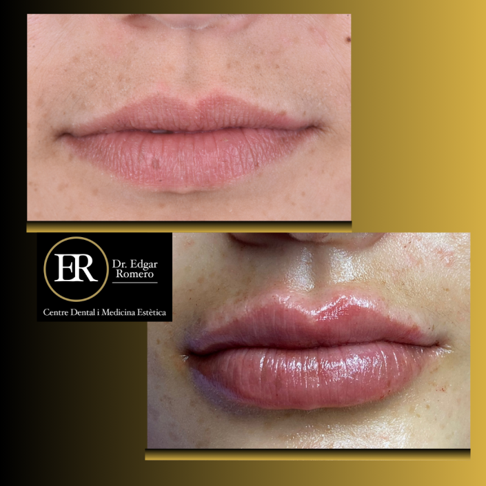 23 Antes y Después de ácido hialurónico