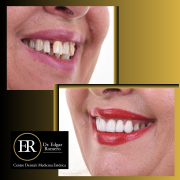 Comparación de dientes antes y después del blanqueamiento dental en Clínica ER Romero en Sabadell.