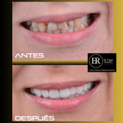 Resultado de implantes dentales en un paciente, antes y después del tratamiento en Clínica ER Romero en Sabadell.