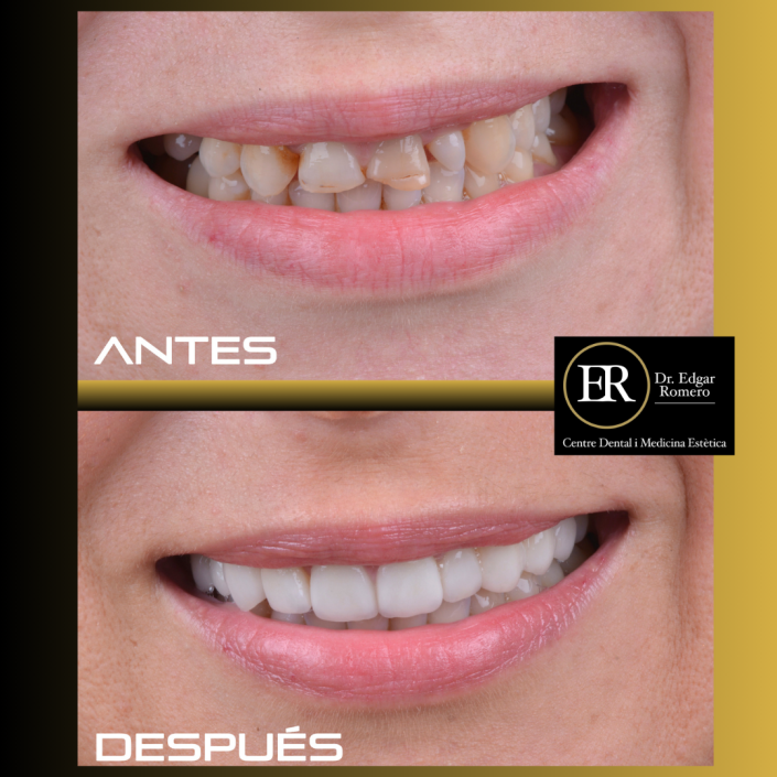 25 esultado de tratamiento de ortodoncia en Sabadell - Antes y Después en Clínica Dental Edgar Romero.