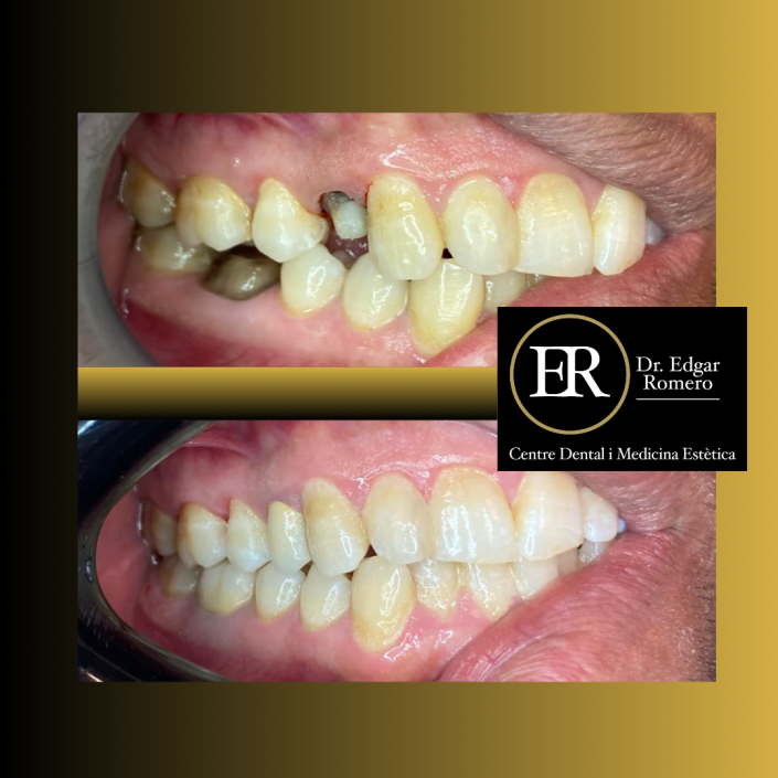 26 esultado de tratamiento de ortodoncia en Sabadell - Antes y Después en Clínica Dental Edgar Romero.