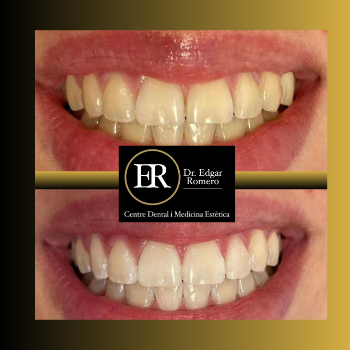 27 Antes y Después de Blanqueamiento Dental