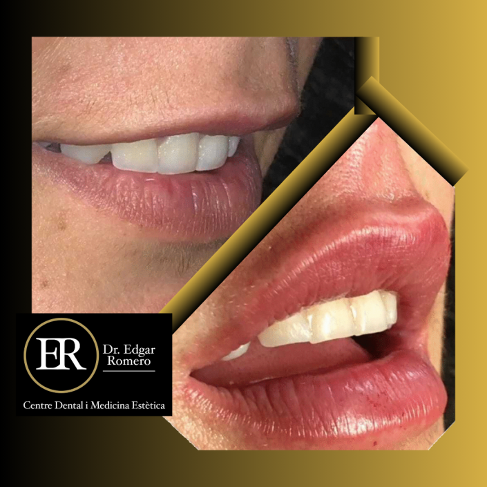 28 Antes y Después de ácido hialurónico