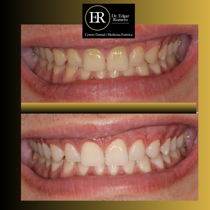 29 Antes y Después de Blanqueamiento Dental