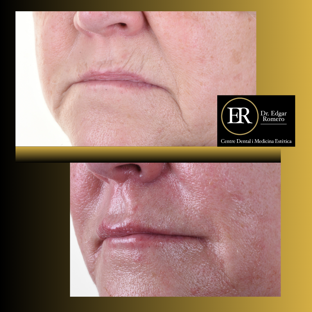 Resultados del Rejuvenecimiento Facial en Sabadell Resultados del rejuvenecimiento facial con ácido hialurónico en la Clínica Dental Edgar Romero en Sabadell.