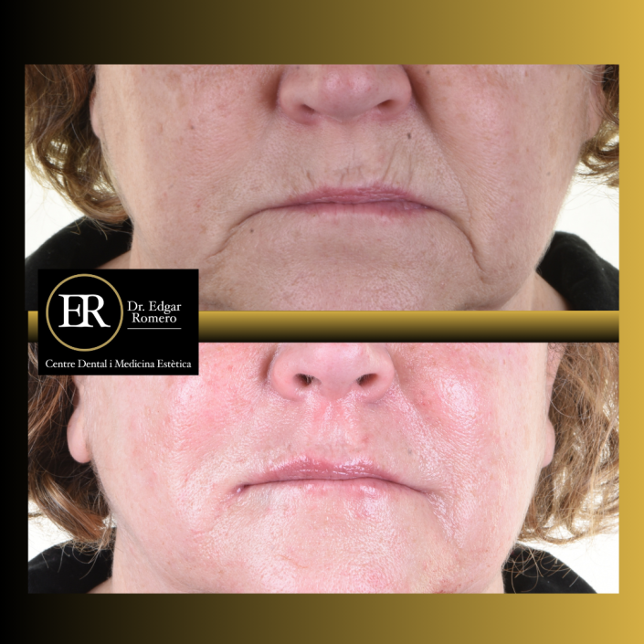 31 Antes y Después de ácido hialurónico