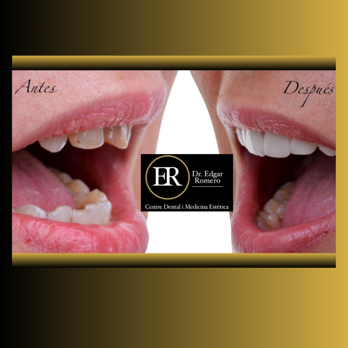 32 esultado de tratamiento de ortodoncia en Sabadell - Antes y Después en Clínica Dental Edgar Romero.