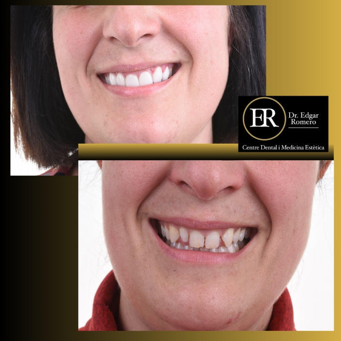 33 esultado de tratamiento de ortodoncia en Sabadell - Antes y Después en Clínica Dental Edgar Romero.