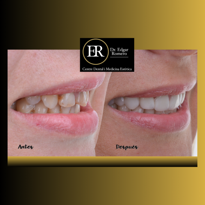 34 esultado de tratamiento de ortodoncia en Sabadell - Antes y Después en Clínica Dental Edgar Romero.