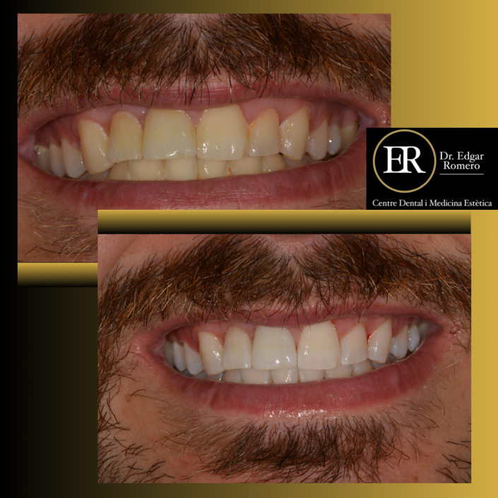 35 Antes y Después de Blanqueamiento Dental