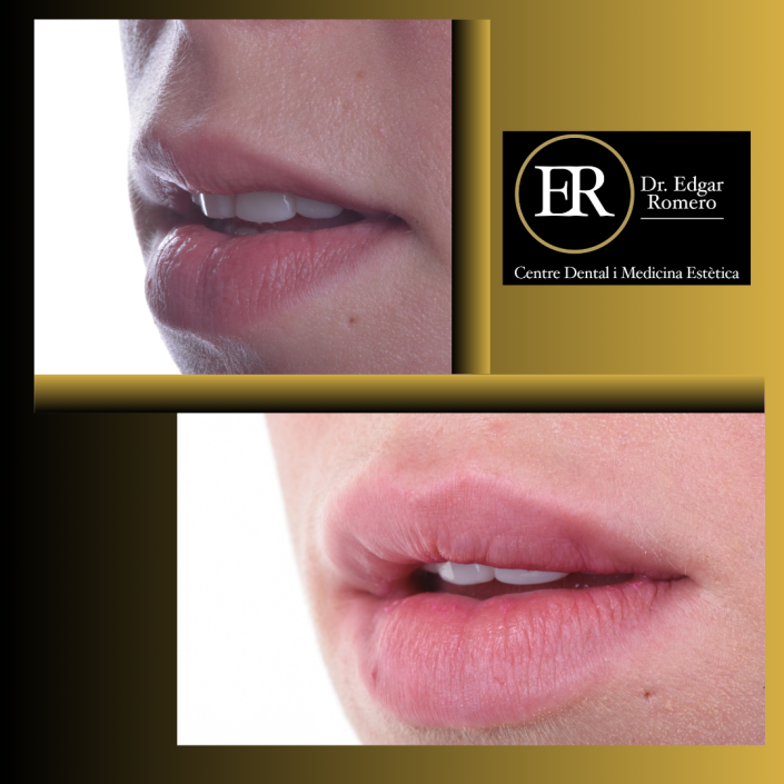 36 Antes y Después de ácido hialurónico