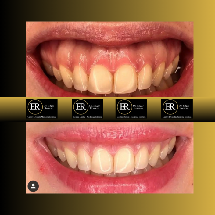 37 Antes y Después de Blanqueamiento Dental